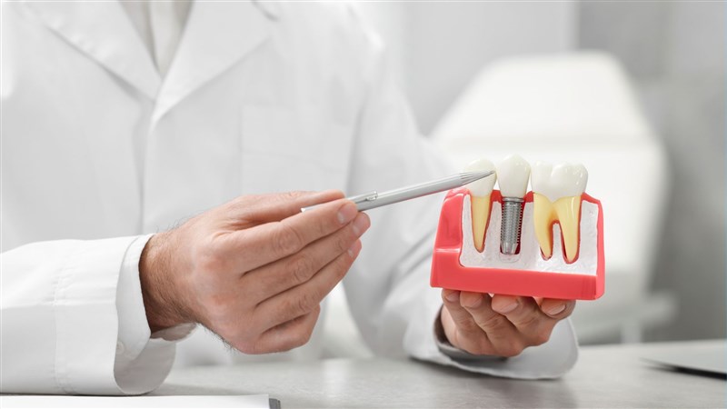 Tác hại của việc trồng răng Implant sai kỹ thuật