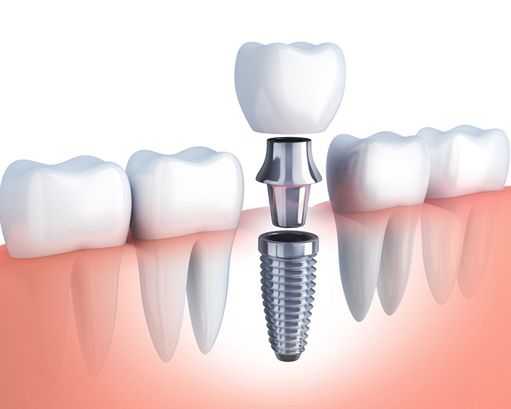 Dịch vụ trồng răng Implant