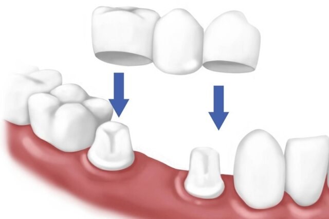 Sau khi trồng răng sứ bị đau nhức? Một số nguyên nhân cụ thể