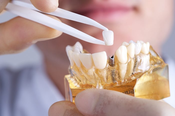 Trồng răng implant bao lâu thì hết đau? bao lâu hồi phục hoàn toàn