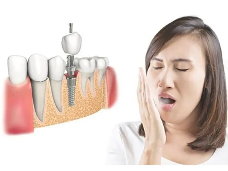 Trồng răng implant có gây hôi miệng không?một số lưu ý quan trọng