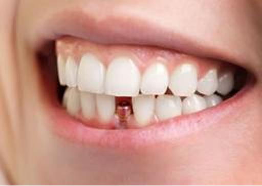 Implant